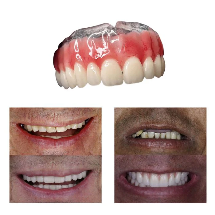 (COMPRE 1 LEVE 2) Dentadura de Silicone FIX | Ajustavel e Adaptativa + Kit de Limpeza de BRINDE - Image 3