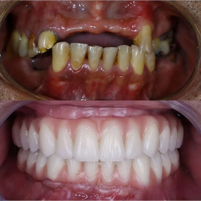 (COMPRE 1 LEVE 2) Dentadura de Silicone FIX | Ajustavel e Adaptativa + Kit de Limpeza de BRINDE - Image 4
